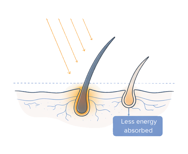Line illustration showing how IPL energy interacts with different skin tones and hair pigment