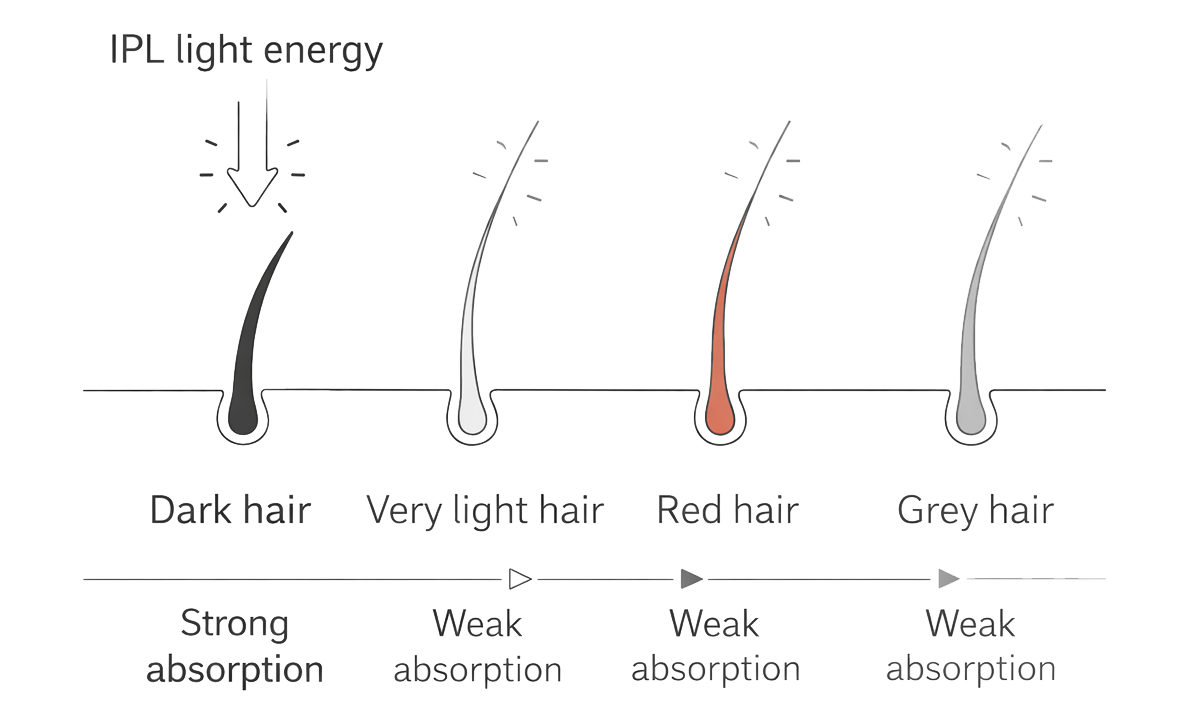 Diagram showing how different hair colors absorb IPL light energy based on pigment levels