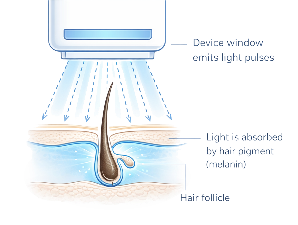 Simplified diagram showing IPL light being absorbed by hair pigment and targeting the hair follicle beneath the skin.
