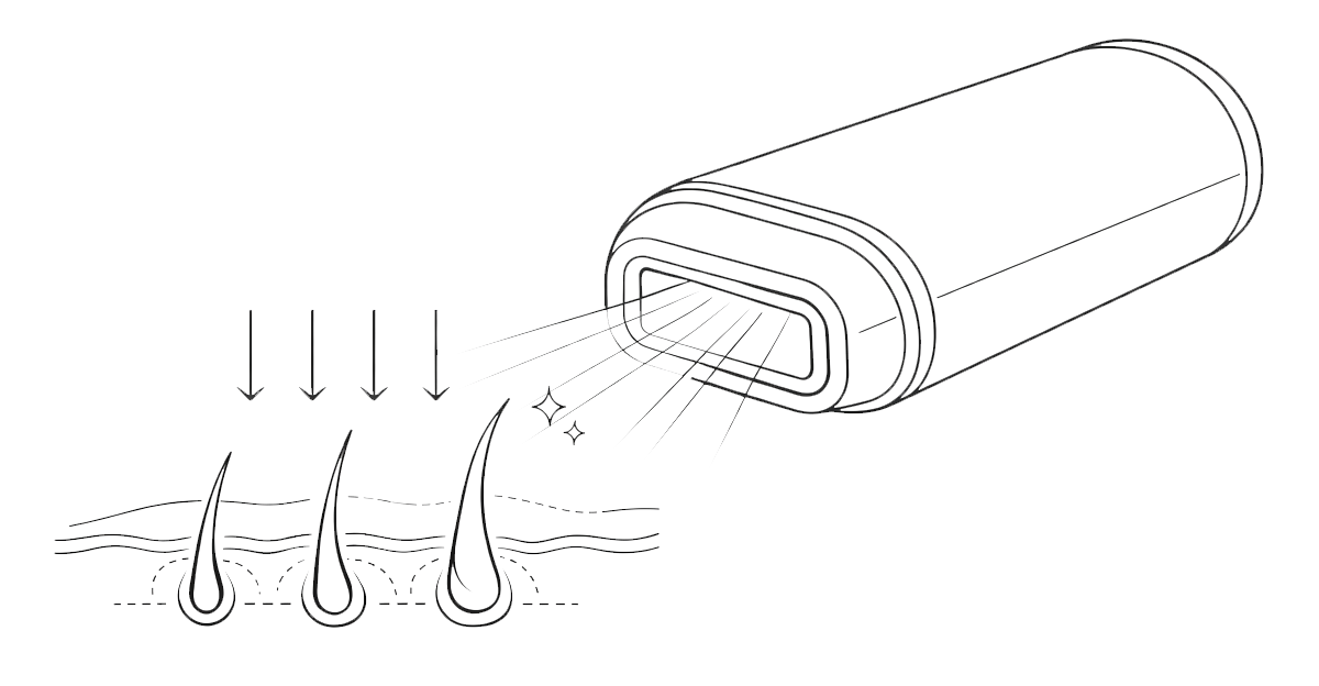 Line diagram showing how IPL light targets hair follicles for gradual hair reduction