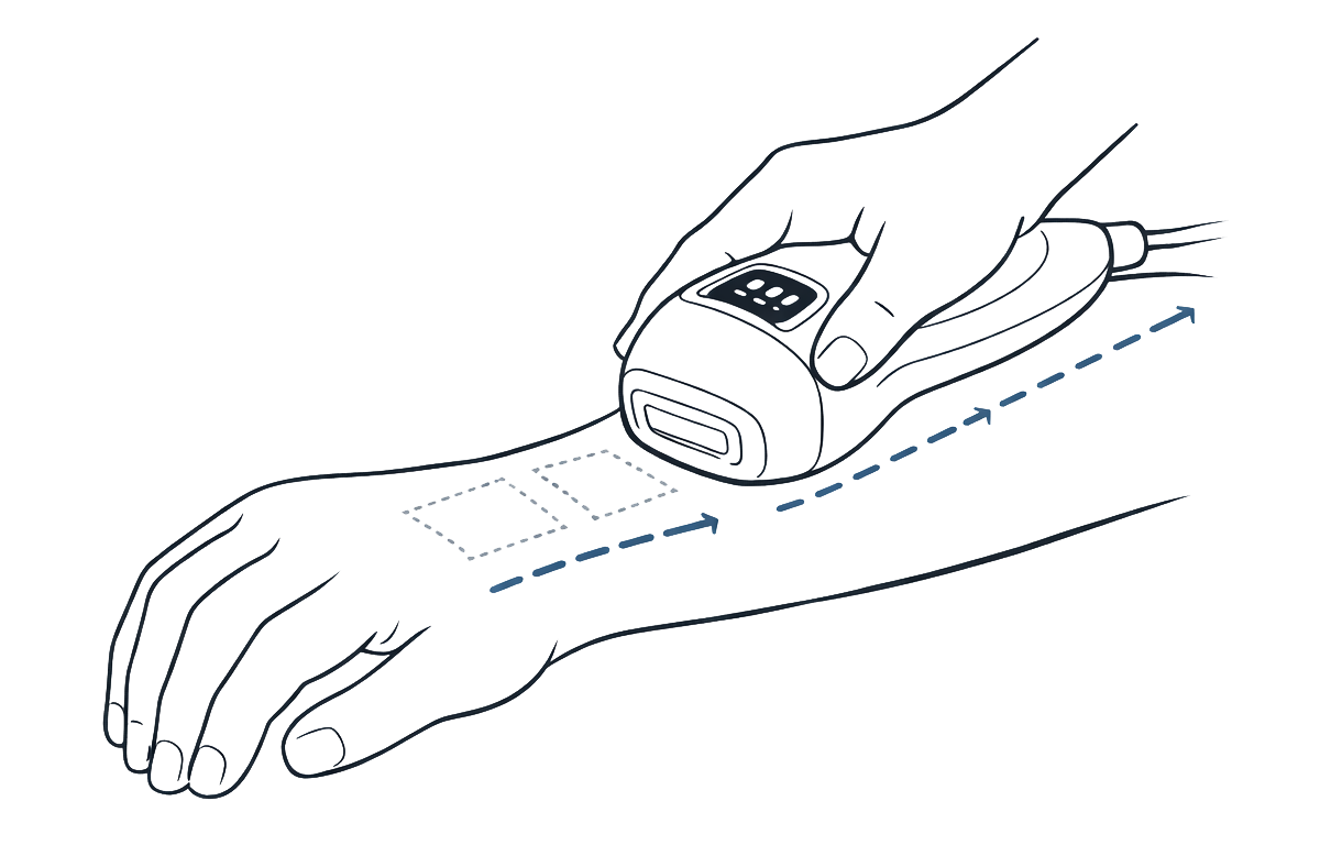 Move slowly and treat one area at a time when using MITHLUX S2 PULSE IPL