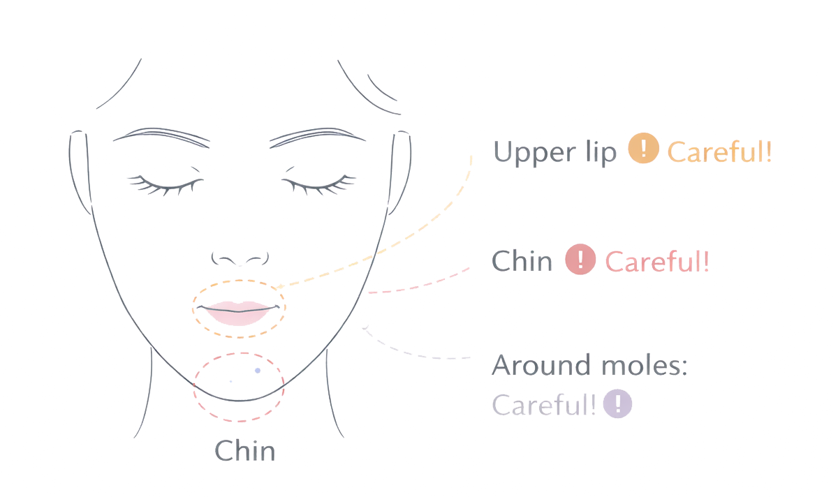 Face areas that need extra care with IPL: upper lip, chin or jawline, and around moles or freckles