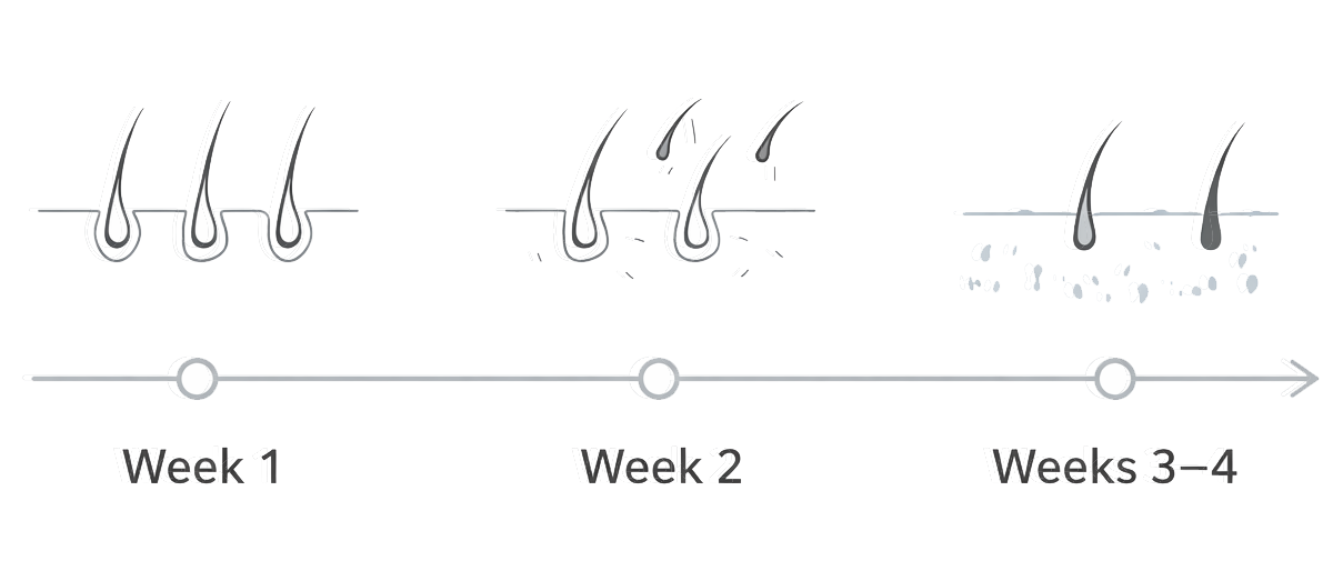 IPL hair shedding timeline after treatment (conceptual): Week 1, Week 2, and Weeks 3–4