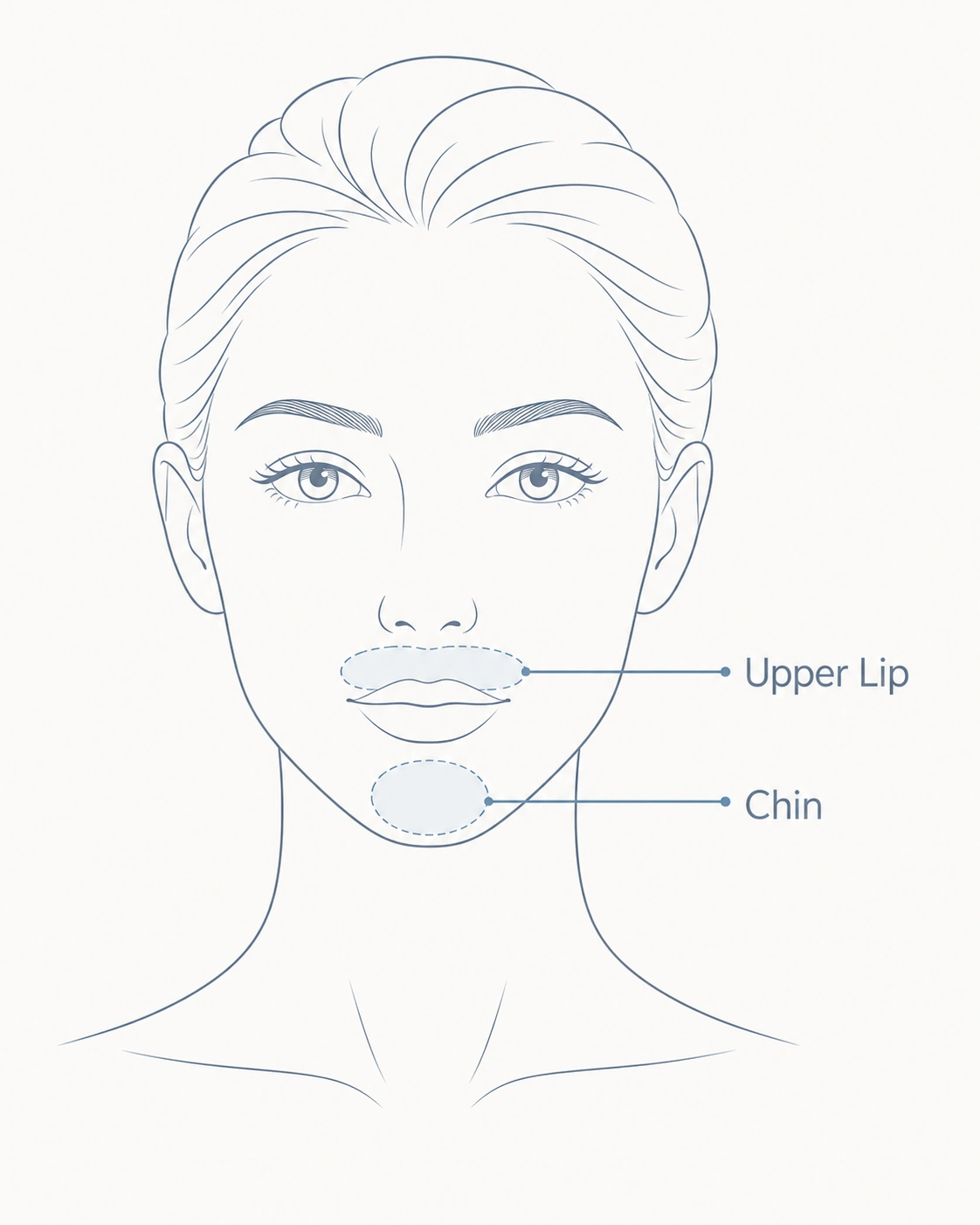 Upper lip and chin IPL treatment areas guide
